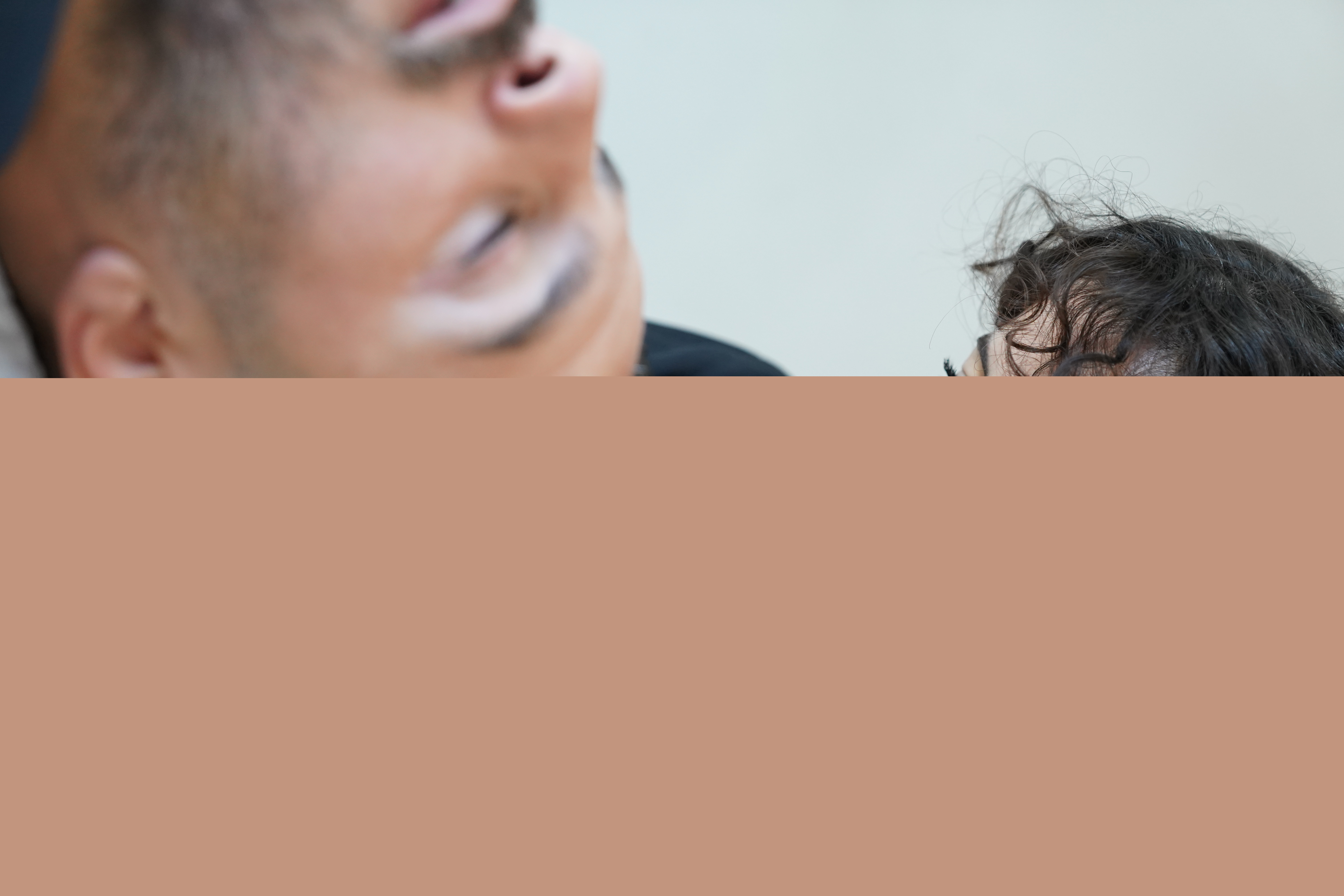 Hair Transplant Image 11