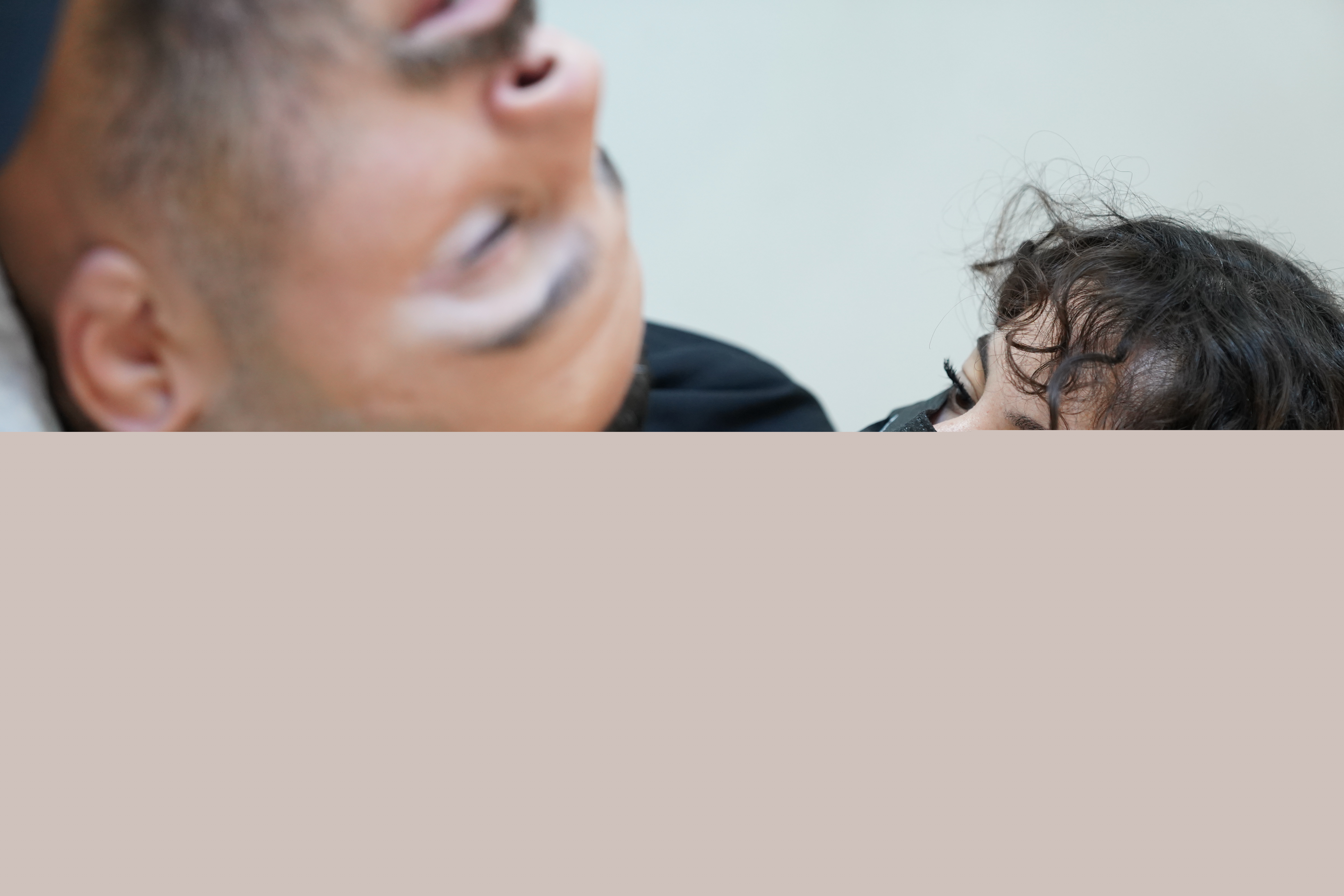 Hair Transplant Image 8